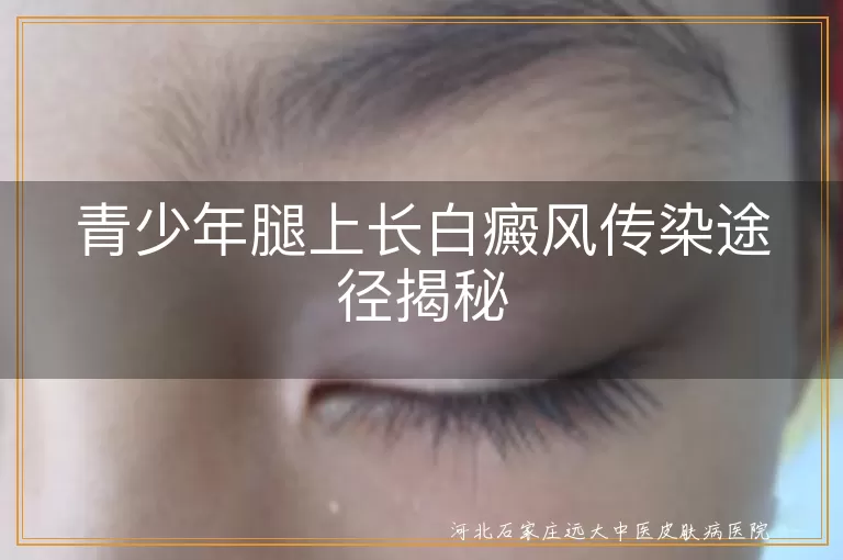 青少年,白癜风,传染途径,遗传因素,自身免疫系统疾病,精神因素,皮肤损伤,环境因素,治疗,心理调适