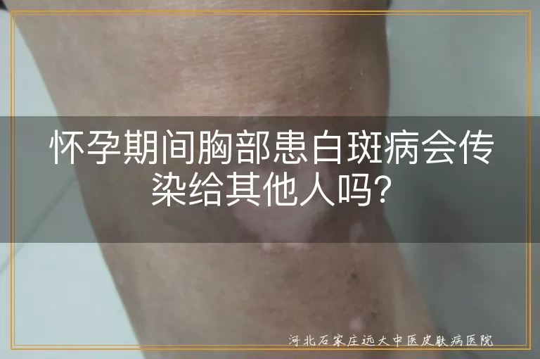 白斑病,白癜风,怀孕,传染性,遗传性,心态调整,合理饮食,避免外伤,慎重用药,家人支持
