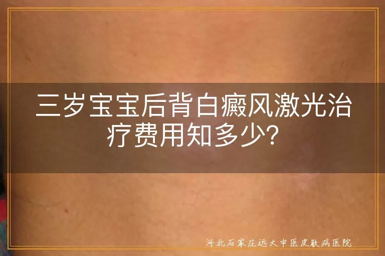 三岁宝宝,白癜风,激光治疗,费用,正规医疗机构,护理措施