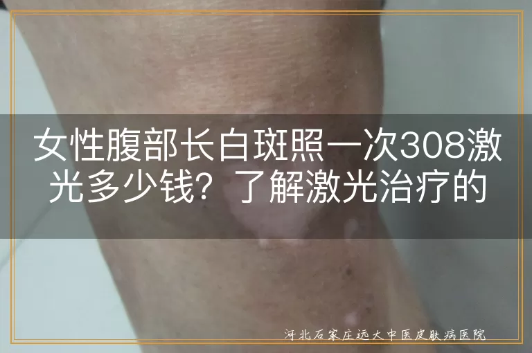 308激光治疗,白斑面积,医院等级,地区差异,治疗设备,治疗次数,费用估算