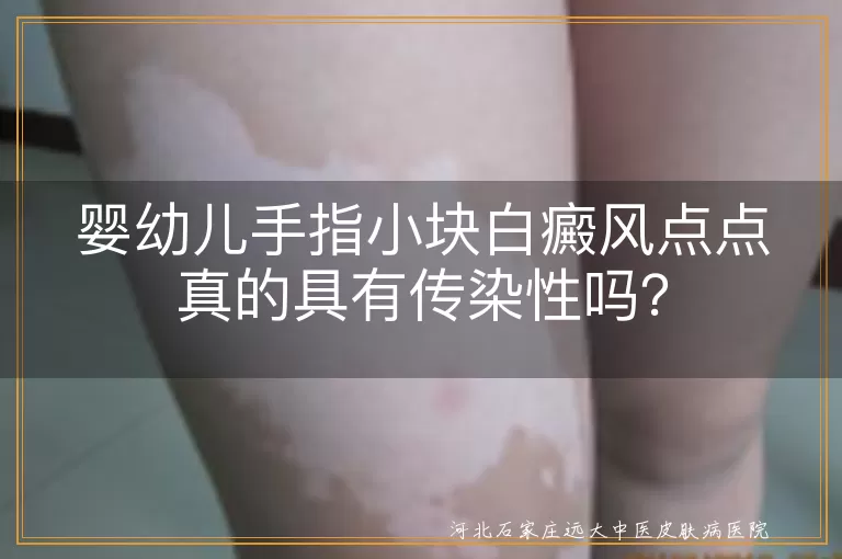婴幼儿,白癜风,传染性,治疗,护理,遗传,自身免疫
