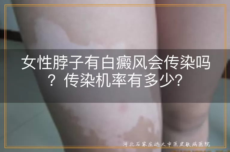 白癜风,传染,女性,脖子,自身免疫性疾病,治疗,预防