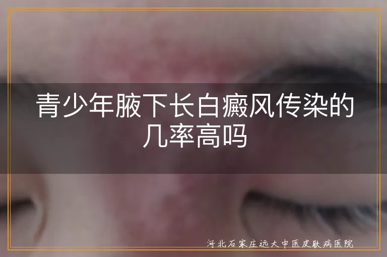 青少年,腋下,白癜风,传染性,遗传,自身免疫,精神心理,外伤,日晒伤,治疗,生活调理