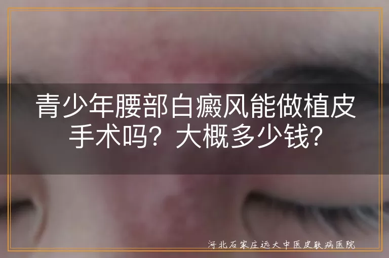 青少年,白癜风,植皮手术,费用,稳定期,复发,护理