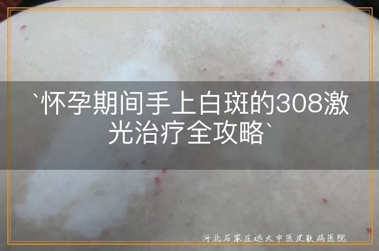 怀孕期间,白斑,308激光治疗,费用,效果,注意事项