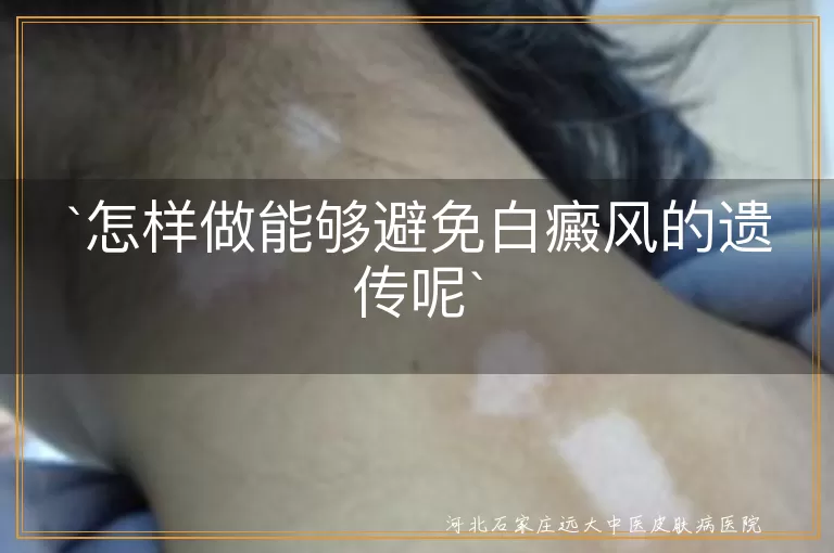 白癜风,遗传,免疫力,不良生活习惯,孕期保健,环境因素,积极治疗