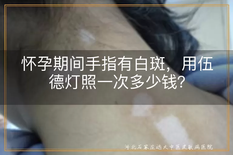 怀孕,白斑,伍德灯,价格,安全,局限性