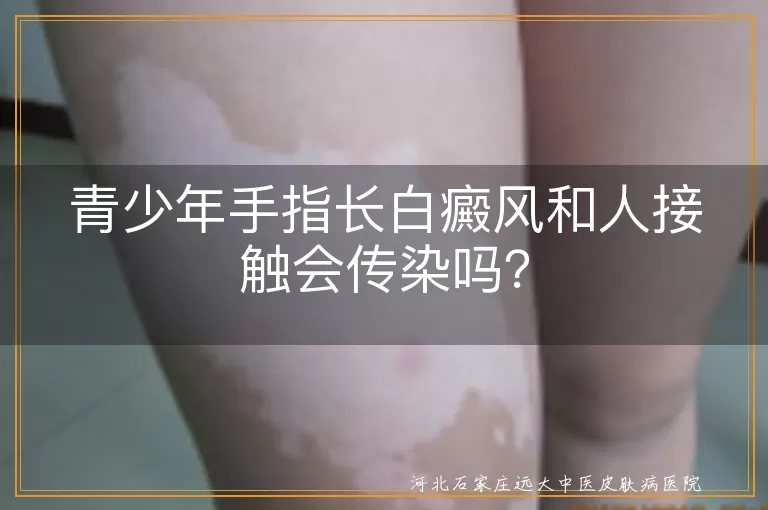 白癜风,传染性,青少年,治疗,预防,饮食调理,皮肤护理,防晒