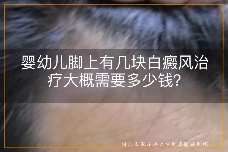 婴幼儿白癜风,治疗费用,药物治疗,光疗,移植治疗