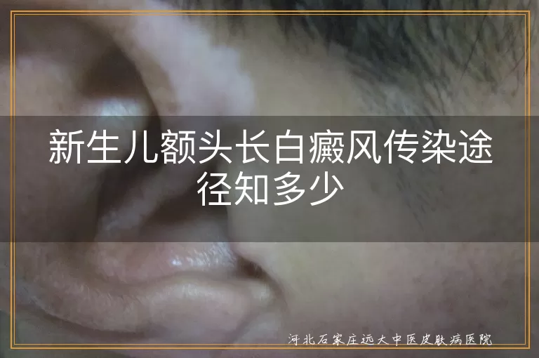白癜风,新生儿,传染途径,遗传因素,自身免疫系统疾病,治疗,护理
