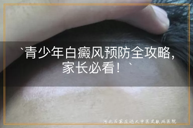青少年白癜风预防全攻略，家长必看！