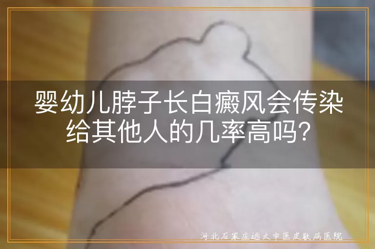 婴幼儿,白癜风,传染,遗传,预防,治疗