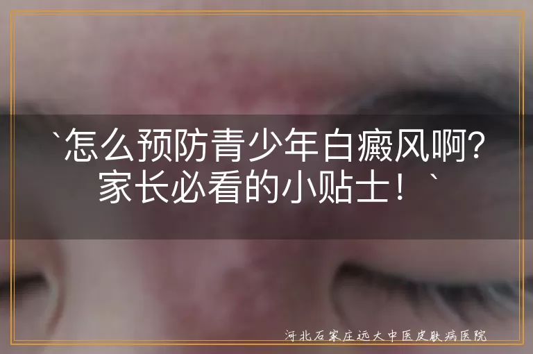 怎么预防青少年白癜风啊？家长必看的小贴士！