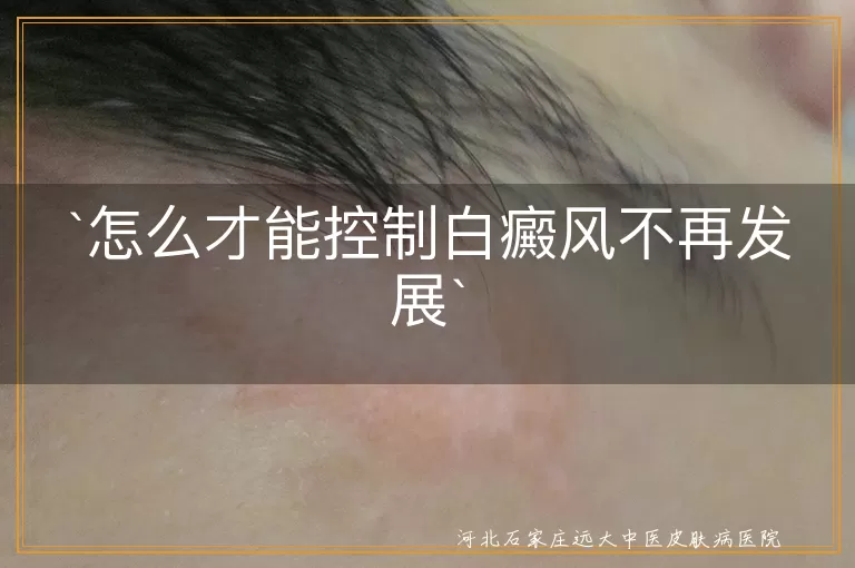 白癜风,控制发展,配合医生治疗,生活细节,辅助治疗,定期复查