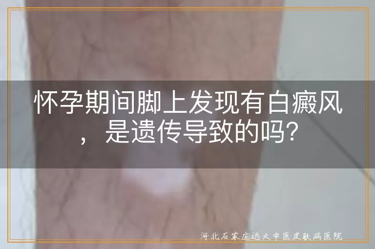 怀孕,白癜风,遗传,治疗,预防,生活细节