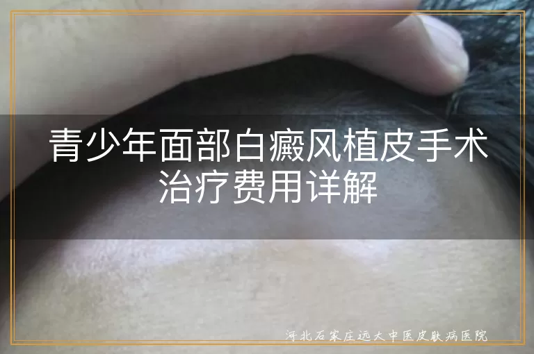 青少年,面部白癜风,植皮手术,费用,治疗