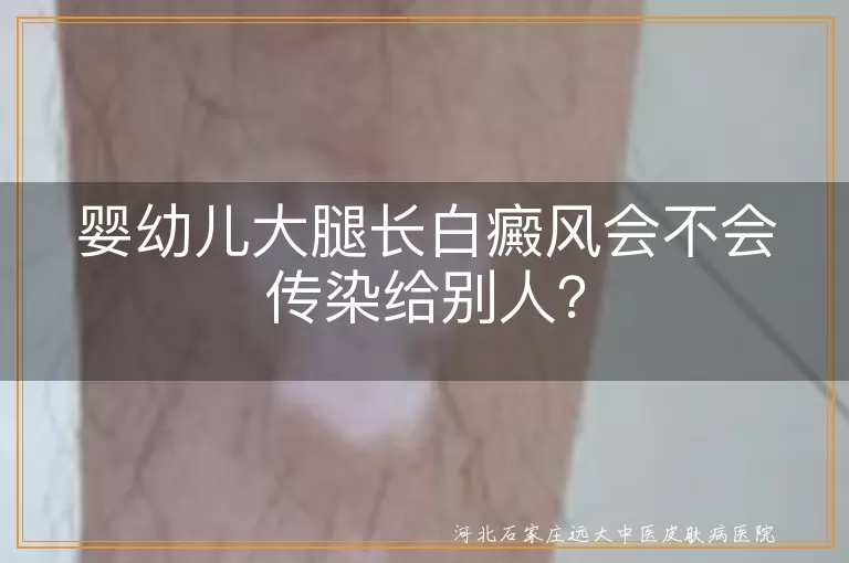 婴幼儿,白癜风,传染性,治疗,心理健康