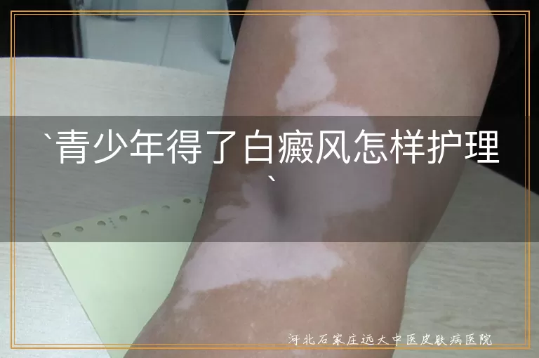 青少年,白癜风,护理,心理支持,饮食调理,日常护肤,定期就医,生活习惯