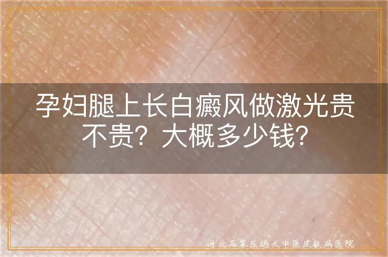 孕妇,白癜风,激光治疗,费用,安全,正规医院