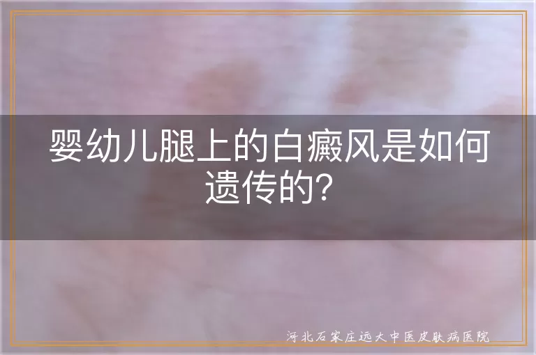 白癜风,婴幼儿,遗传,常染色体显性遗传,治疗,预防
