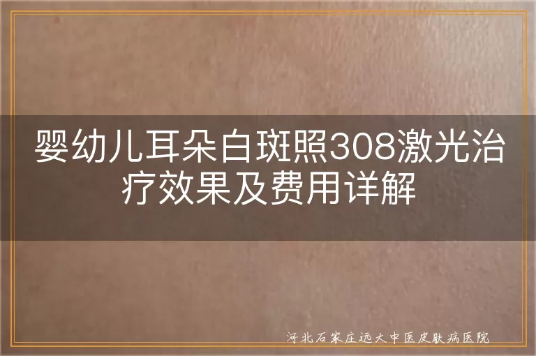 婴幼儿,耳朵白斑,308激光治疗,效果,费用,正规医院,护理
