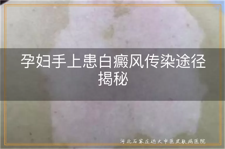 白癜风,孕妇,传染途径,预防,护理