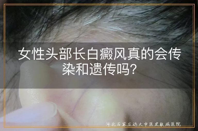 白癜风,传染,遗传,女性,头部,护理,治疗,生活方式