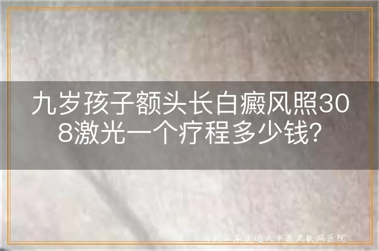 九岁孩子额头长白癜风照308激光一个疗程多少钱？