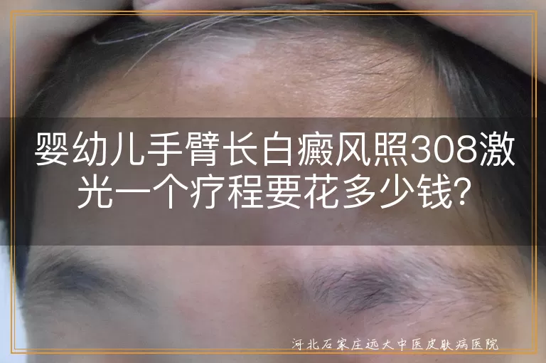 婴幼儿,白癜风,308激光治疗,费用,病情严重程度,医院等级,地区差异