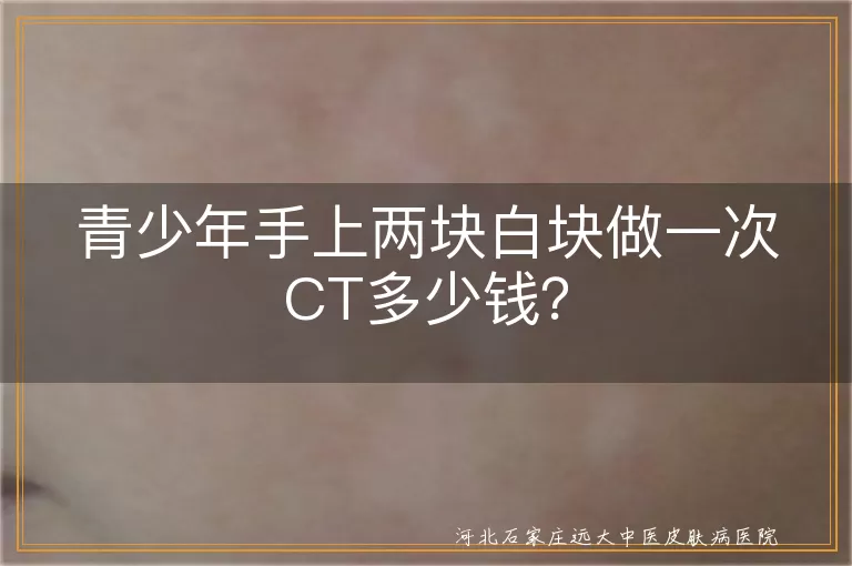 青少年,手上白块,CT检查,费用,地区差异,医院级别,检查需求