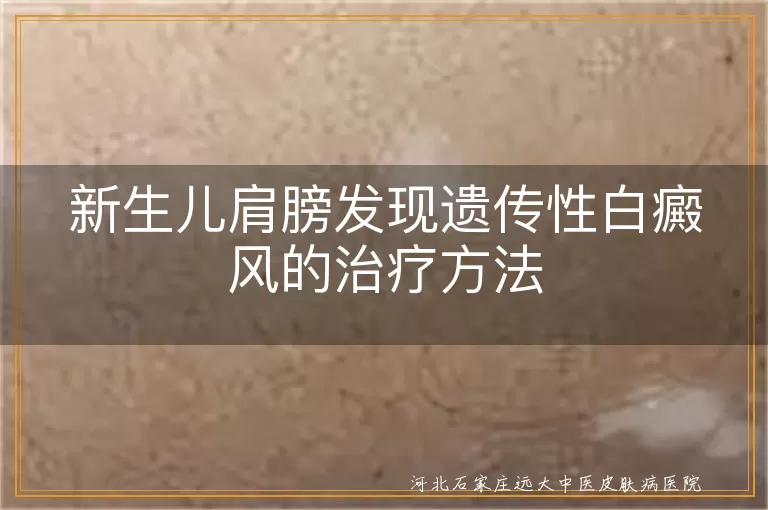 新生儿,遗传性白癜风,治疗方法,光疗,激光治疗,皮肤移植,心理关怀,饮食健康