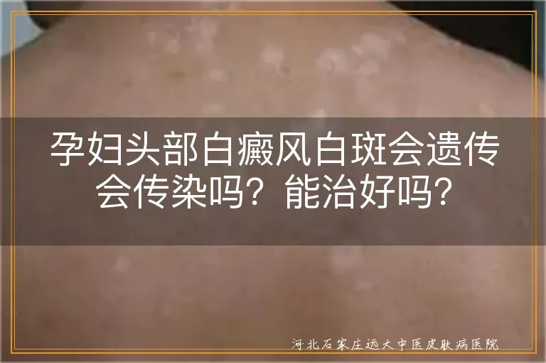 孕妇,白癜风,白斑,遗传,传染,治疗