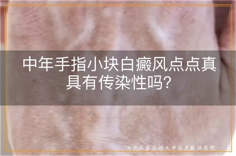 白癜风,传染性,黑色素细胞,治疗,防晒,心态