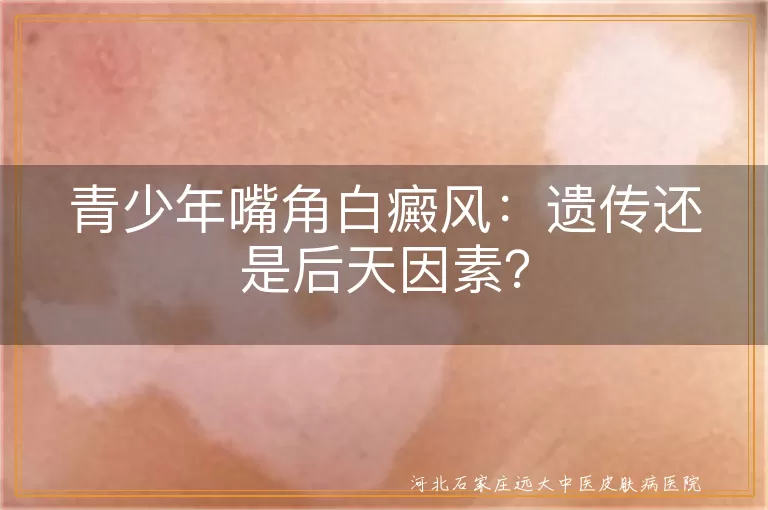 青少年,嘴角白癜风,遗传因素,后天因素,预防,治疗