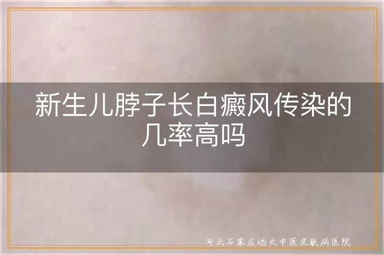 新生儿,白癜风,传染,遗传,预防,治疗
