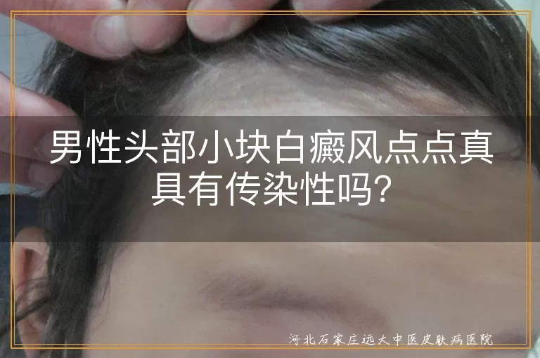 男性头部白癜风,传染性,自身免疫,遗传,治疗,日常护理