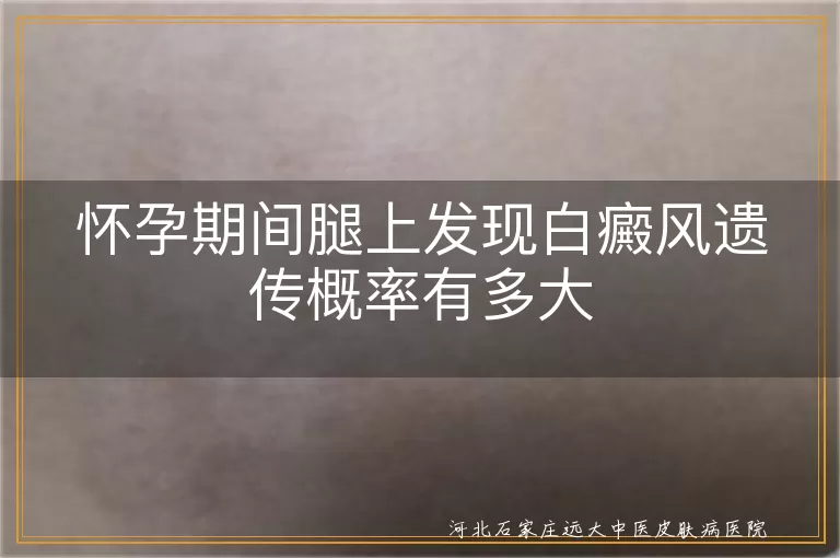 怀孕期间白癜风遗传概率,白斑遗传几率,孕期白癜风遗传风险,白癜风遗传倾向