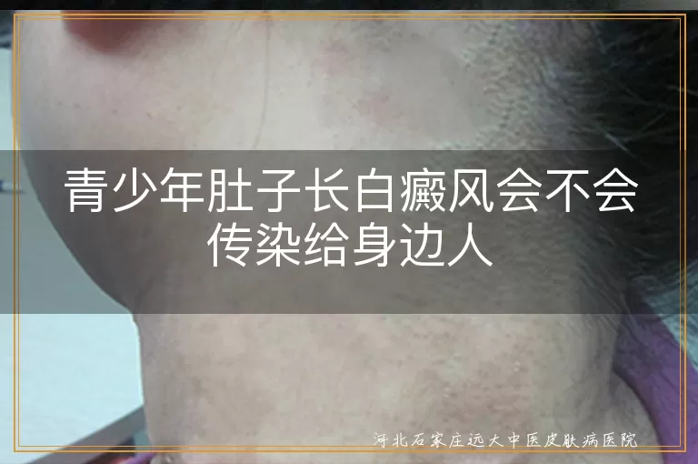 青少年白癜风传染性,白癜风是否会传染,白斑病不传染,白癜风非传染病