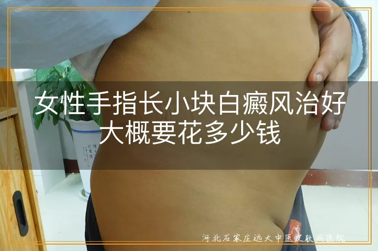 女性手指白癜风治疗费用, 白癜风治疗价格, 白斑治疗成本, 白癜风康复花费