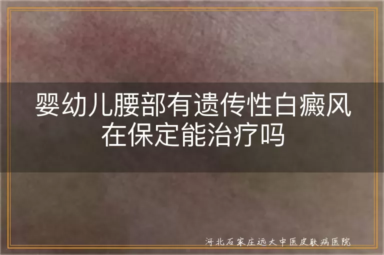 婴幼儿腰部白癜风治疗,保定白癜风医院,遗传性白癜风,白斑病治疗