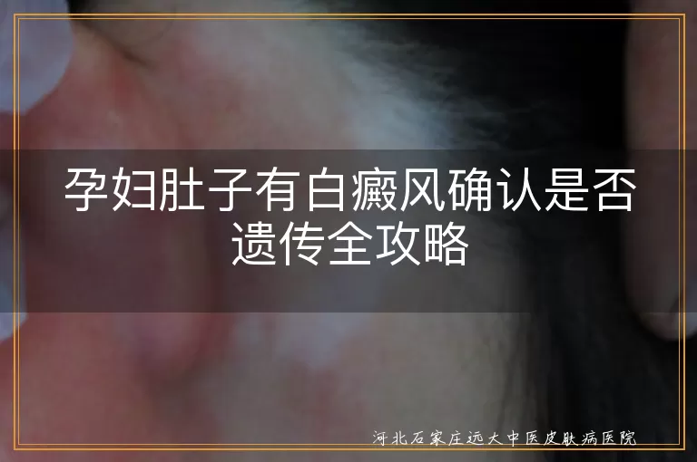 孕妇白癜风遗传概率,白斑遗传咨询,白癜风家族病史影响,孕期白斑管理