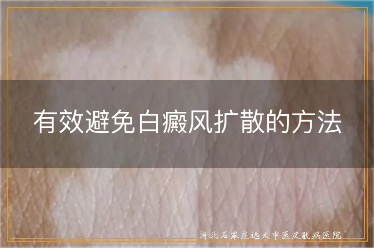 白癜风预防扩散方法,白斑控制技巧,白癜风日常护理,白斑科学治疗