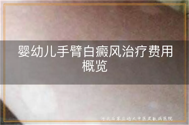 婴幼儿手臂白癜风治疗费用, 婴幼儿白斑治疗费用, 婴幼儿白癜风治疗价格, 婴幼儿白斑治疗价格