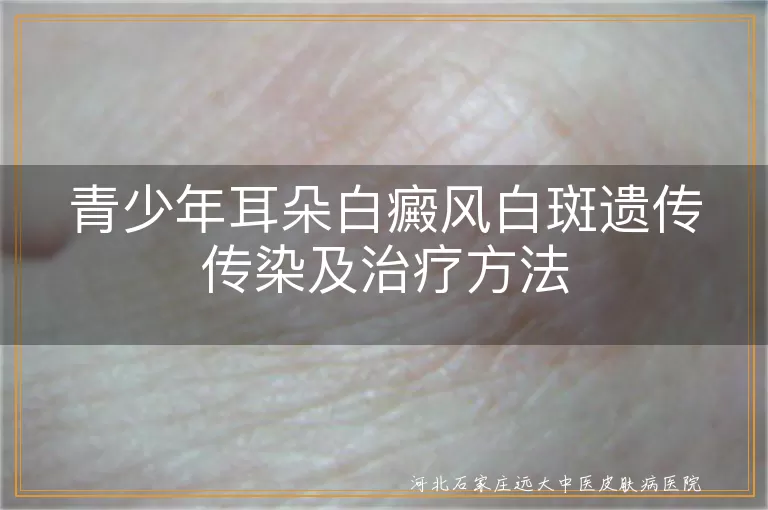 青少年耳朵白癜风遗传吗,白癜风白斑是否传染,青少年白斑能否治好,耳朵白癜风治疗方法