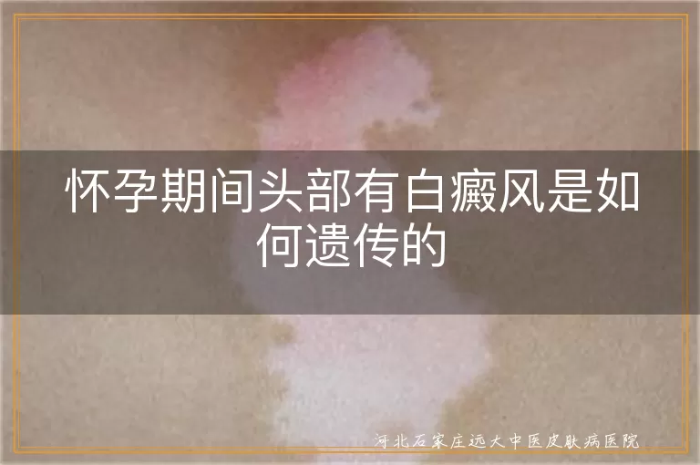 怀孕期间白癜风遗传规律,头部白癜风遗传方式,白斑遗传概率,白癜风家族遗传风险