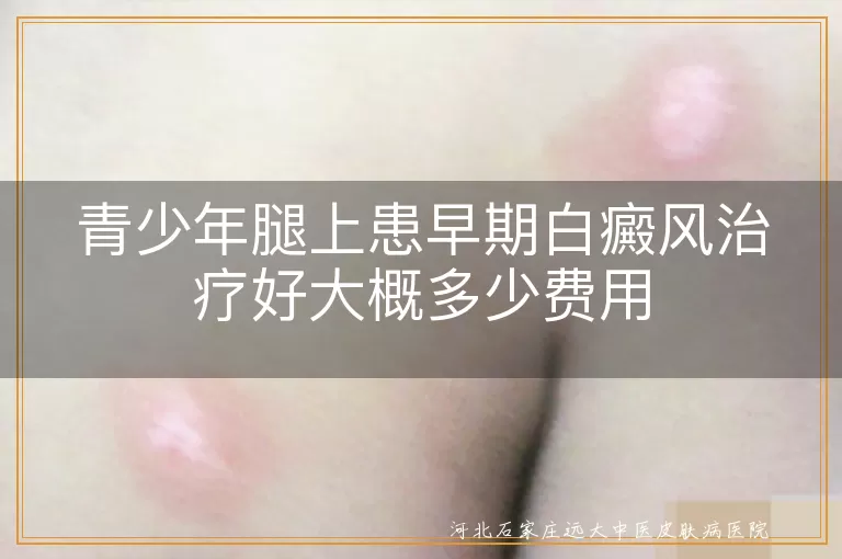 青少年腿上白癜风治疗费用,早期白癜风治疗费用,白斑治疗费用,白癜风治疗预算