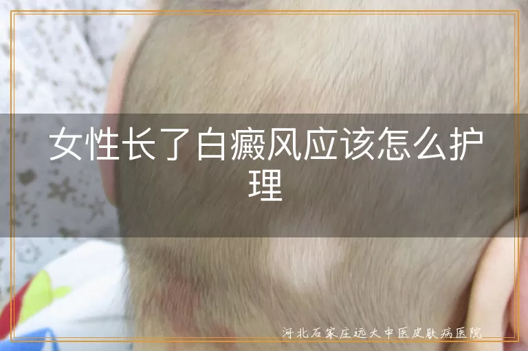 女性白癜风护理方法,白癜风患者防晒指南,白癜风饮食调理建议,白斑皮肤日常护理