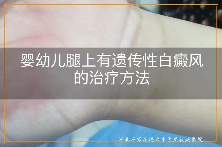 婴幼儿白癜风治疗方法,遗传性白斑治疗,婴幼儿白斑护理,白斑病治疗