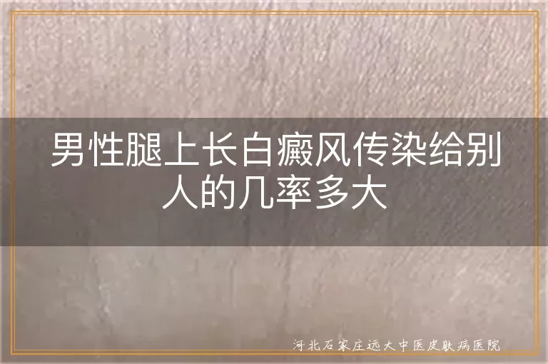 男性腿上白癜风传染概率, 白癜风遗传几率, 白癜风非传染性疾病, 白斑传染性问题