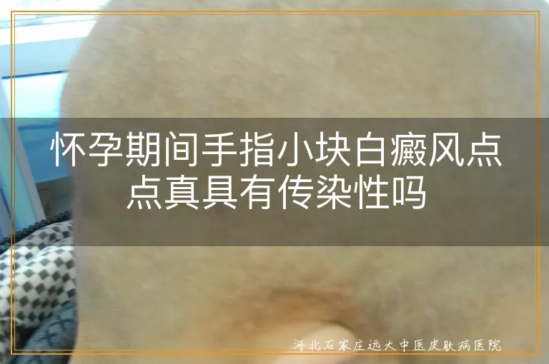 怀孕期间白癜风传染性,白斑遗传风险,孕期白癜风管理,白癜风日常护理